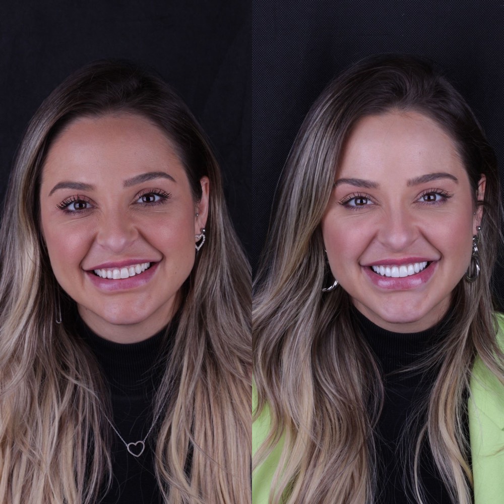 Antes e depois de paciente após reabilitação do sorriso