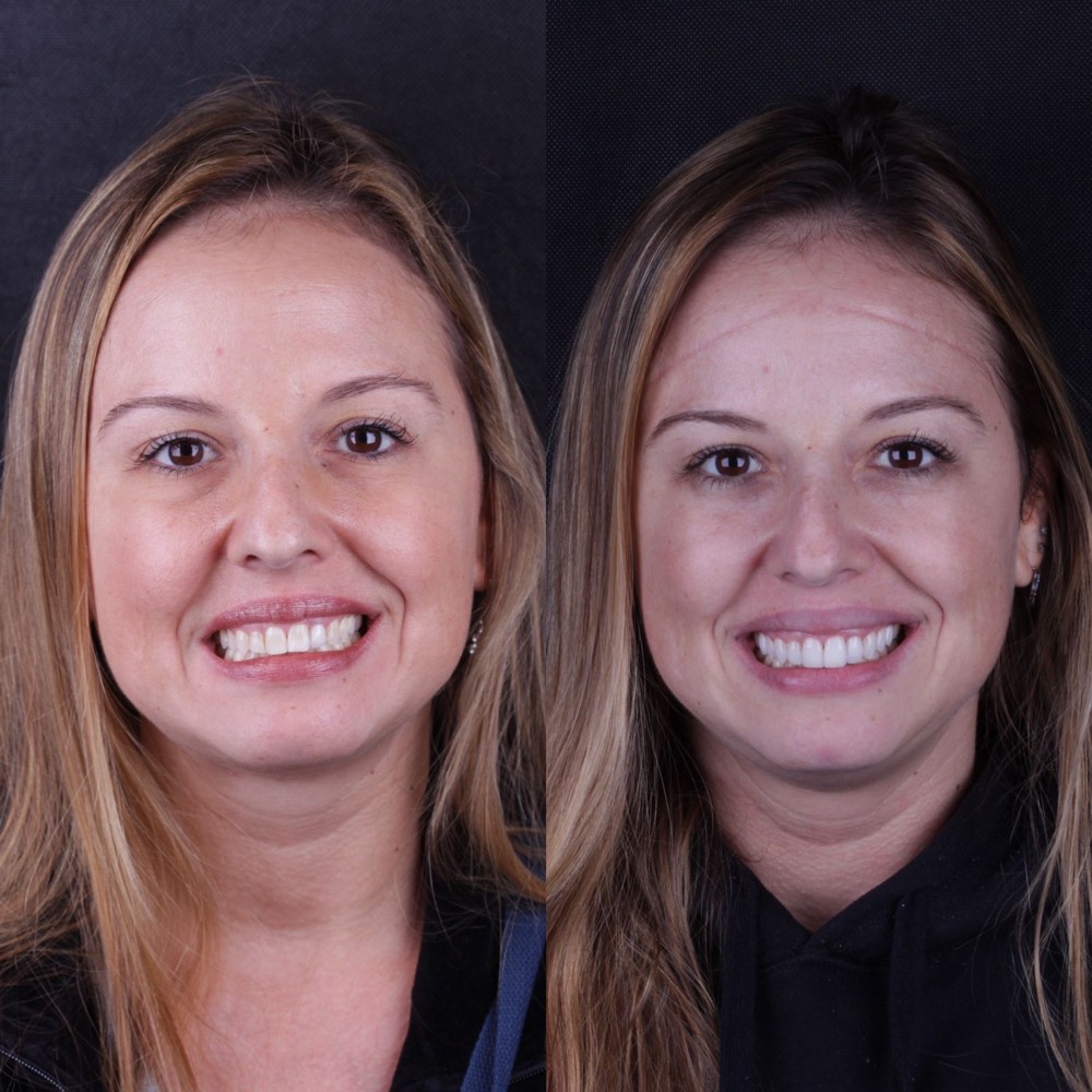 Antes e depois de paciente após tratamento