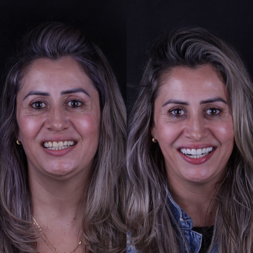Antes e depois de paciente após tratamento