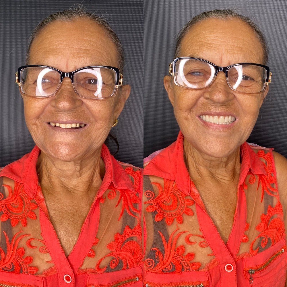 Antes e depois de paciente após reabilitação com prótese
