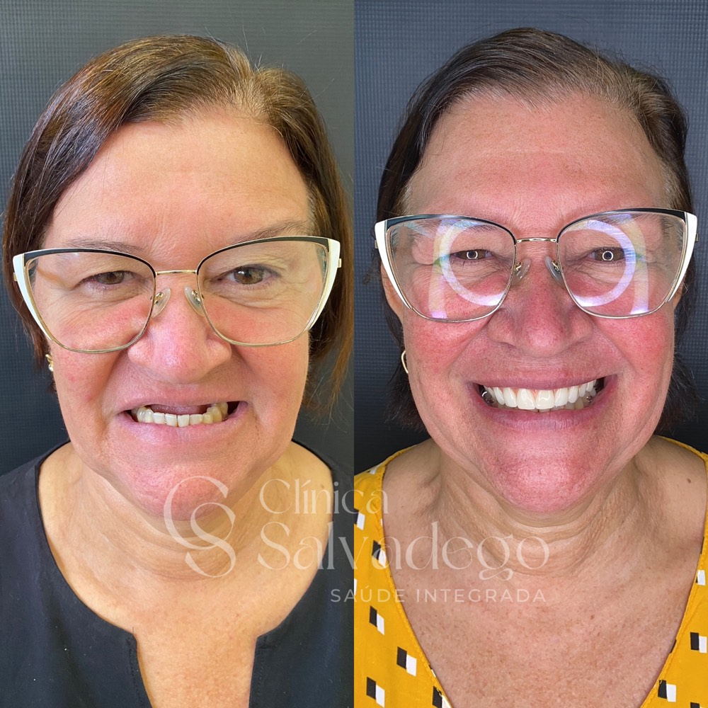 Antes e depois de paciente após reabilitação com prótese