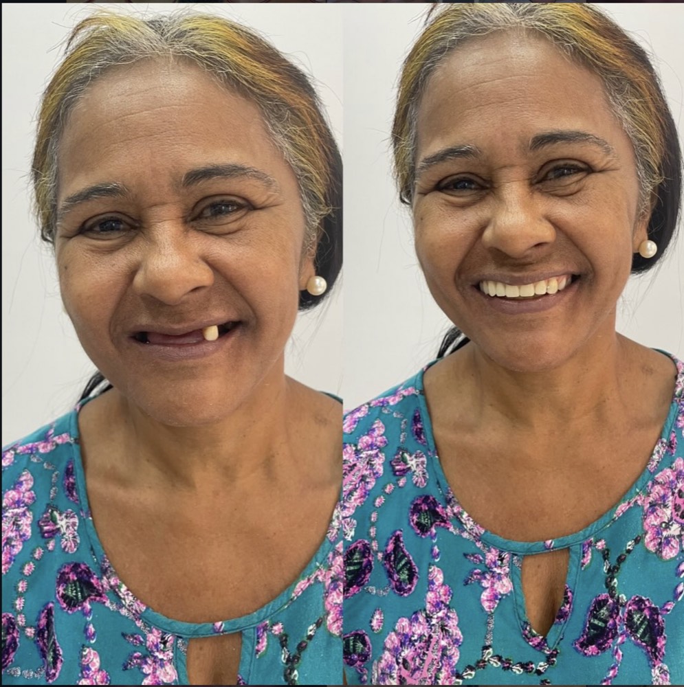 Antes e depois de paciente após reabilitação com prótese