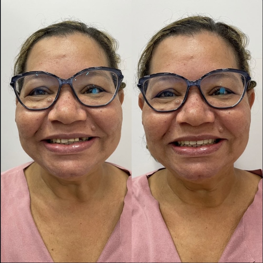 Antes e depois de paciente após reabilitação com prótese
